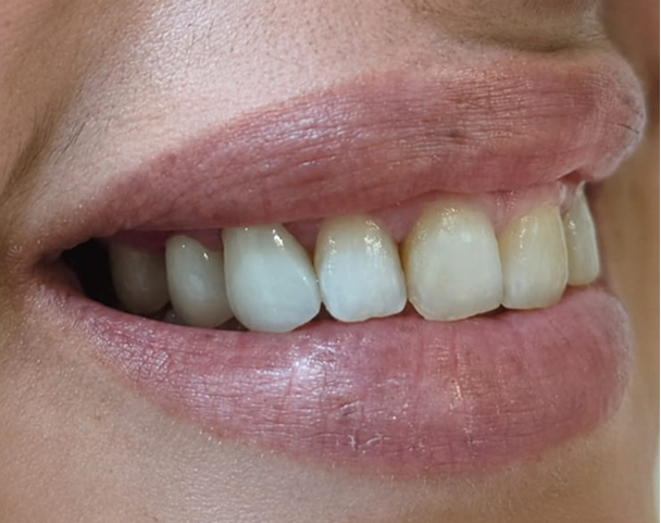 Depois - Restauração estética