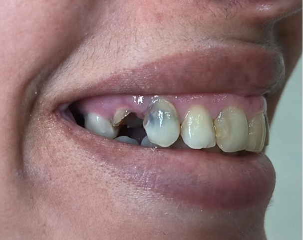 Antes - Restauração estética