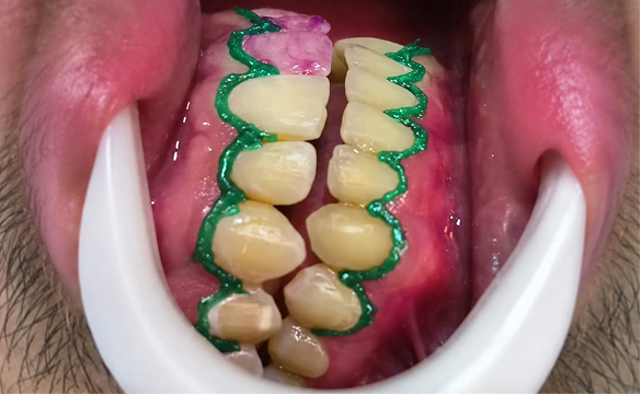 Antes - Clareamento Dental